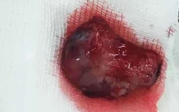 Удалённая менингиома