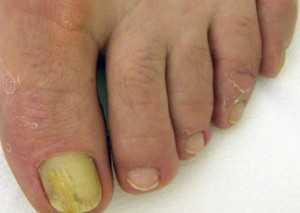 онихомикоз