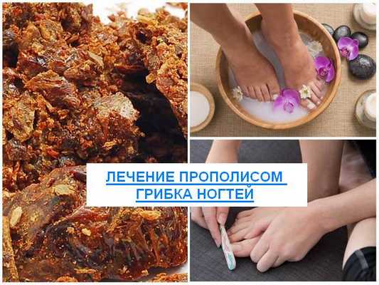 Лечение прополисом грибка ногтей