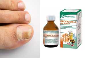 Регулярно используйте прополис, и грибок отступит