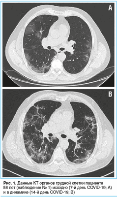 Рис. 1. Пациентка 66 лет, с многолетним анамнезом (не менее 20 лет) неконтролируемой артериальной гипертензии. Острый дебют когнитивных нарушений с последующим постепенным регрессом. На момент осмотра: MMSE 22 балла, выраженная амнезия, конструктивная апр