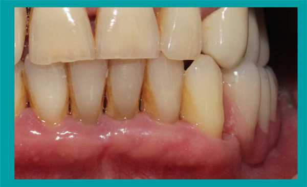 Итоговый вид реставрации