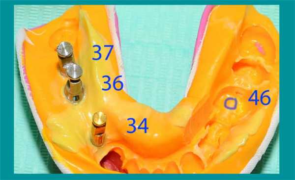 Слепки с аналогами имплантов для проработки индивидуальных зубных протезов