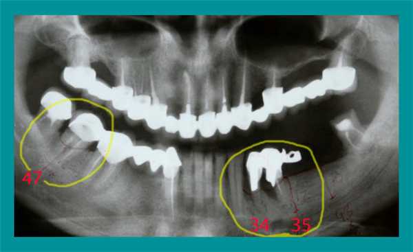 Ортопантомограмма, проведенная во время первого визита