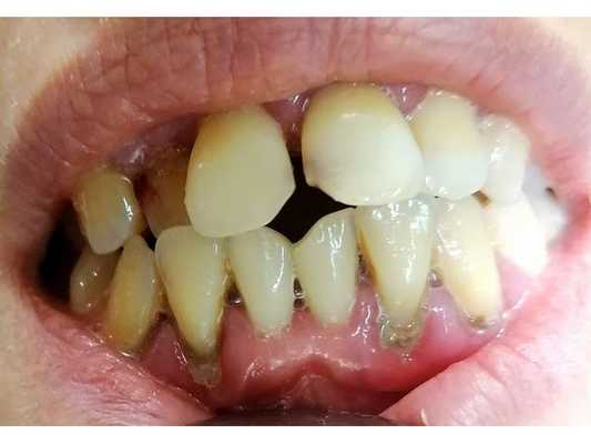 Хронический генерализованный пародонтит средней степени тяжести в стадии обострения (фото до лечения)