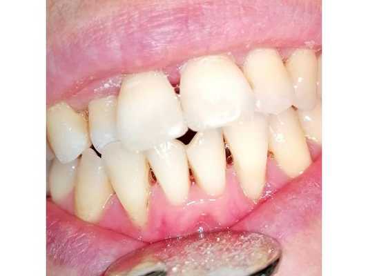 Хронический генерализованный пародонтит в стадии ремиссии (фото после лечения)
