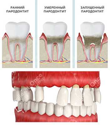 хронический пародонтит стадии