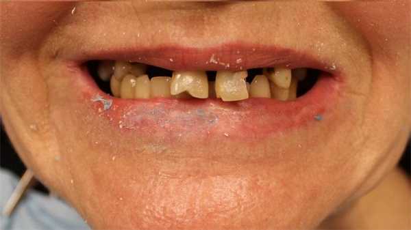 Реабилитация пациента с хроническим генерализованным пародонтитом и субтотальной атрофией верхней челюсти