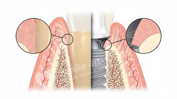 специальные импланты при пародонтите