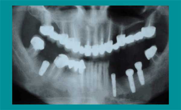 Ортопантомограмма после установки имплантатов