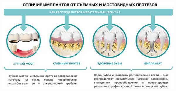 Отличие имплантов от съемных протезов