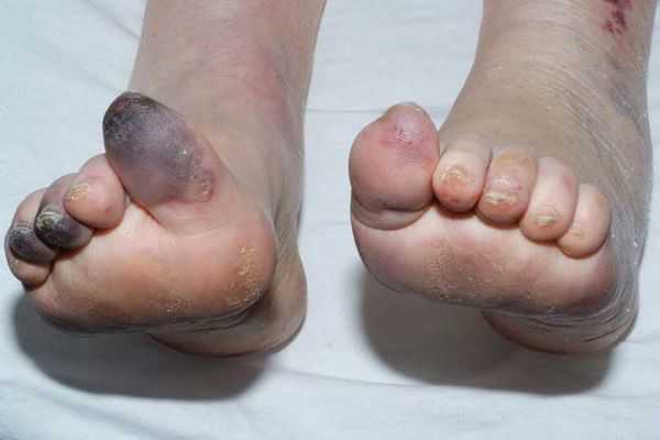 Некроз тканей