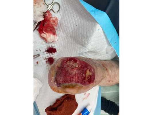 Культя стопы спустя 4 месяца после операции