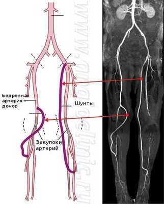 Аутовенозное шунтирование позволяет восстановить кровообращение даже при поражении артерий голени и стопы