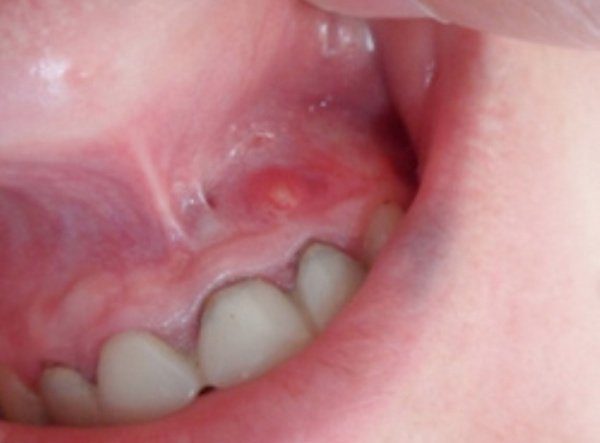 Апикальный периодонтит