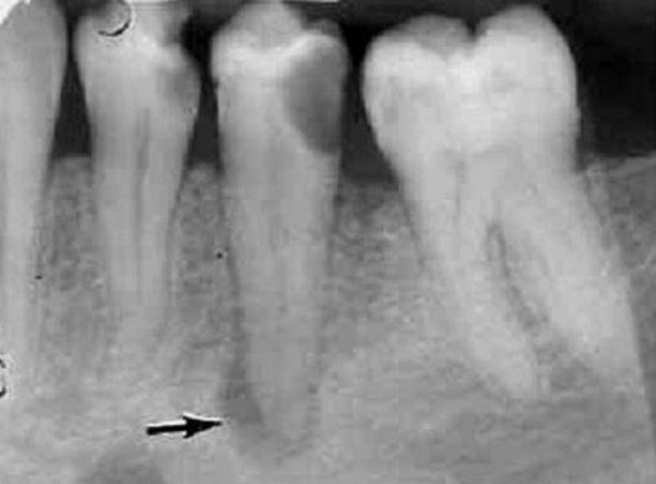 Рентген зуба. Верхушечный периодонтит