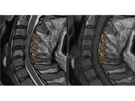 МРТ шейного отдела позвоночника: в Т2-режиме видны миелопатические очаги в сегменте С3-С6 на фоне абсолютного стеноза с уровня С3-С4 до С5-С6