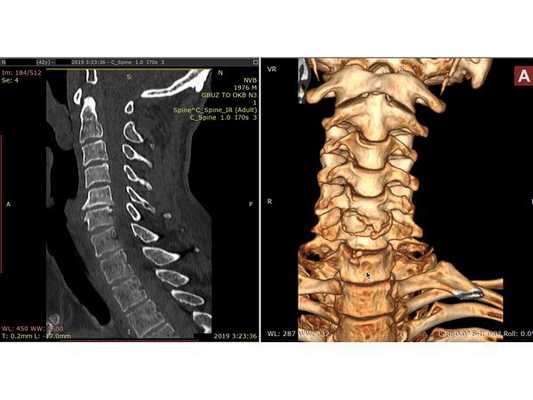 КТ шейного отдела позвоночника: выраженный спондилёз в сегменте С5-С6