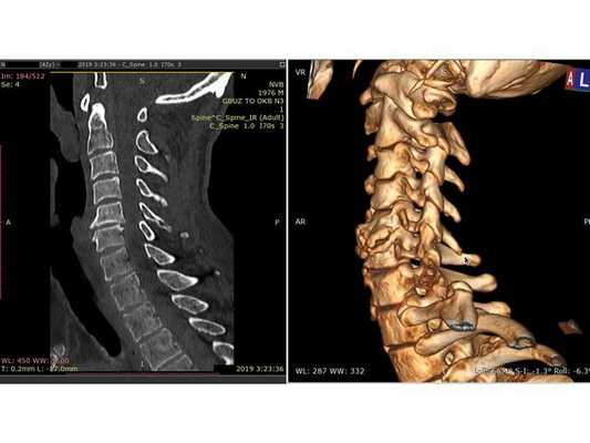  КТ шейного отдела позвоночника: выраженный спондилёз в сегменте С5-С6 (позвонки не сломаны)