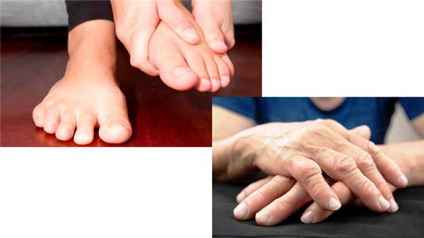 Симптомы серопозитивного артрита