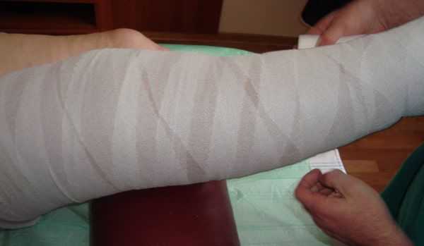 Бандажирование про лимфедеме