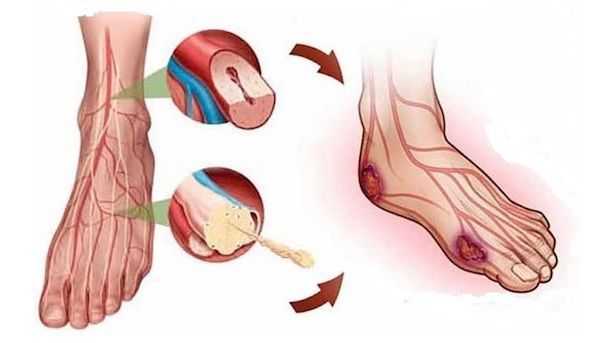 Патогенез трофической язвы