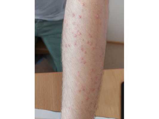 Стероидные акне на левой руке после лечения коронавирусной инфекции