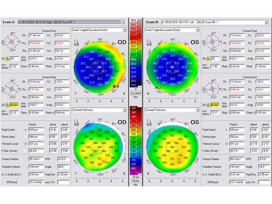 Результаты кератотопографии на аппарате Oculyzer II