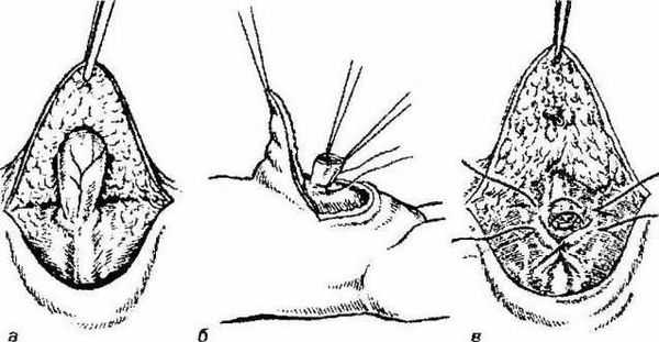 Операция по удалению пупочной грыжи