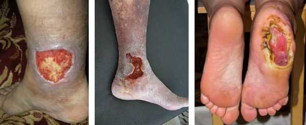 Трофические язвы