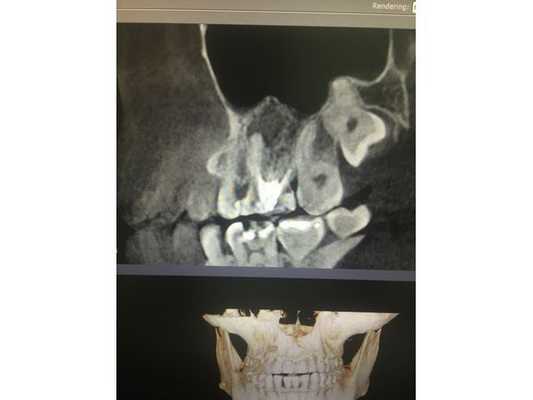 Зуб 2.6 до лечения