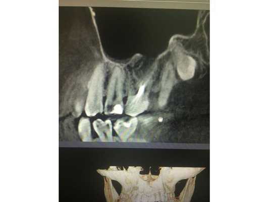 Зуб 2.6 до лечения 