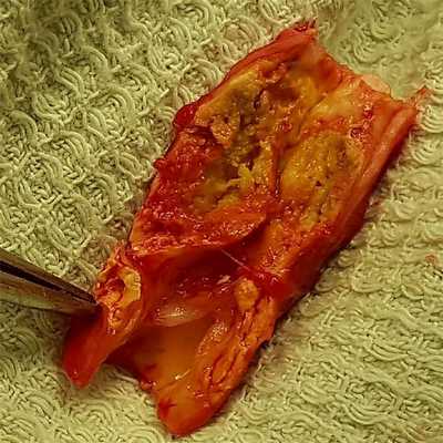 Атеросклеротическая нестабильная бляшка в сонной артерии