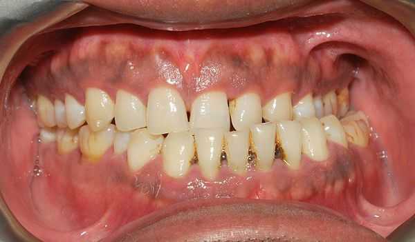 Перекрещивание зубных рядов