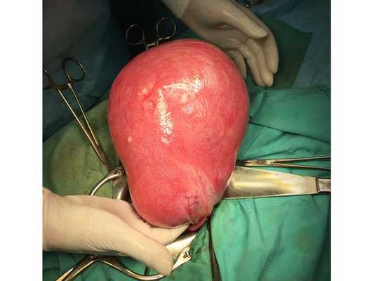 Гигантская миома матки (вид после вскрытия передней брюшной стенки)