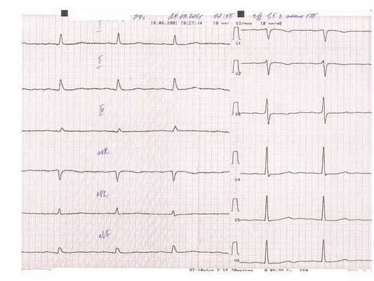 ЭКГ через полтора часа после тромболитической терапии