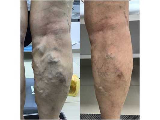 Задняя часть правой ноги до и через 2 месяца после лечения