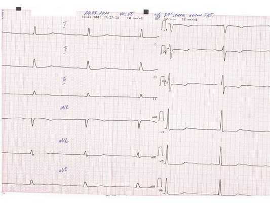 ЭКГ через 30 минут после тромболитической терапии