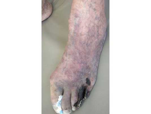 Некроз пальцев левой стопы