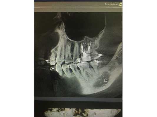 Костная ткань в периапикальной области полностью восстановлена