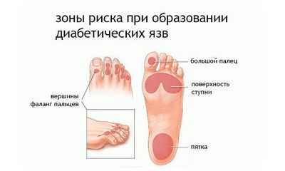 Трофическая язва на ноге: места поражения