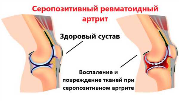 Патогенез серопозитивного артрита