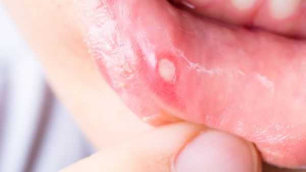 Афтозный стоматит