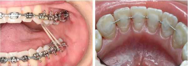 Брекет-система и ретейнер