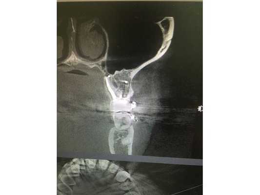 Зуб 2.6 после лечения. Видно восстановление костной ткани в периапикальной области