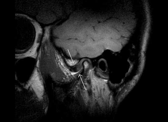 МРТ височно-нижнечелюстного сустава