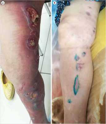 Состояние левой нижней конечности на момент обращения пациента в медицинское учреждение и спустя 3 мес. от начала лечения