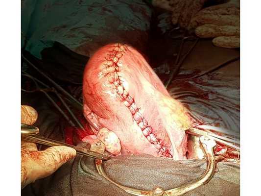 Результат операции — матка сохранена, миоматозные узлы, в том числе и гигантский, удалены