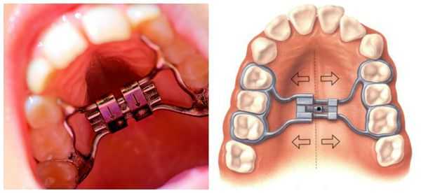 Расширяющая пластинка на верхнюю челюсть