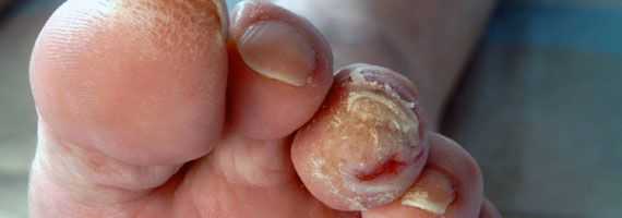 Шелушение кожи при диабетической стопе